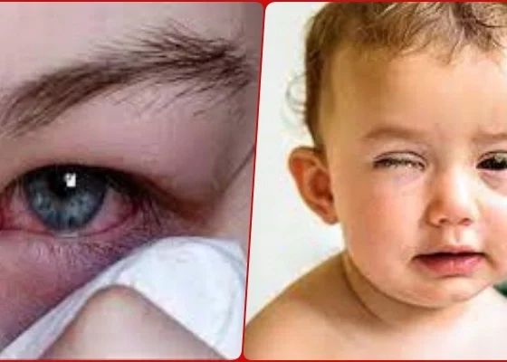 Conjunctivitis-Eye Flu outbreak of eye disease, be careful