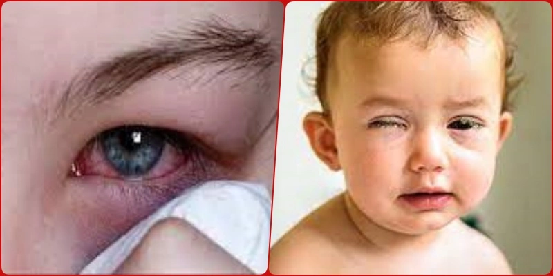 Conjunctivitis-Eye Flu: आंखों की बीमारी का फैला प्रकोप, हो जाइए सावधान