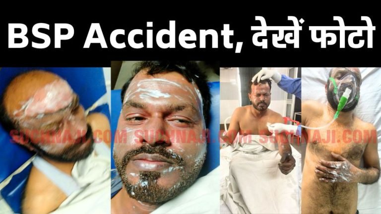 Bhilai-Steel-Plant-See-the-shocking-photo-of-3-workers-burnt-in-the-accident