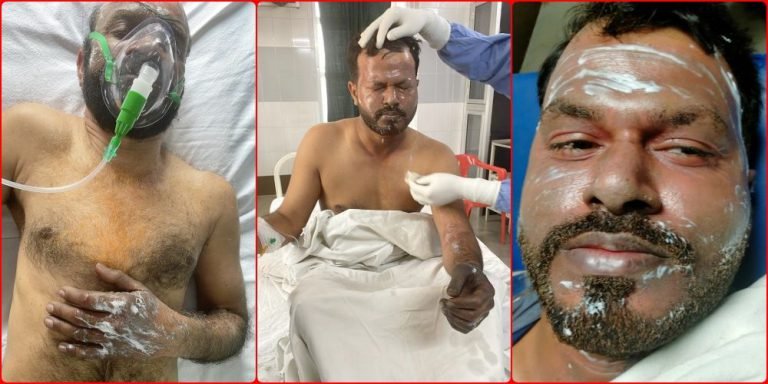 Big-update-in-Bhilai-Steel-Plant-accident-3-workers-burnt-CITU-investigated-flaw-exposed