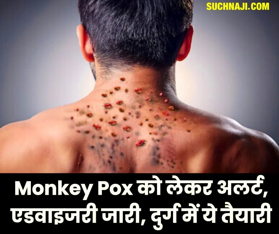 Monkey Pox को लेकर अलर्ट, एडवाइजरी जारी, पढ़िए जानलेवा वायरस के बारे में