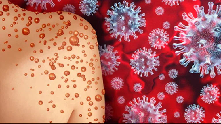 Big-News-Measures-to-prevent-monkeypox-take-precautions-like-this-and-do-not-do-this-at-all-experts-of-Durg-told