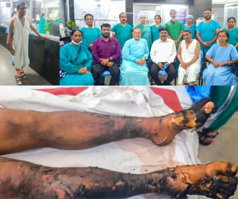Both the legs of the worker were burnt in the Bhilai Steel Plant accident, he got a new life from the burn ward