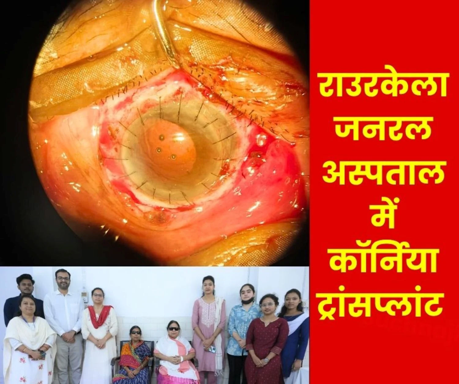 SAIL Rourkela Steel Plant Cornea Transplant at IGH, Eyesight Restored